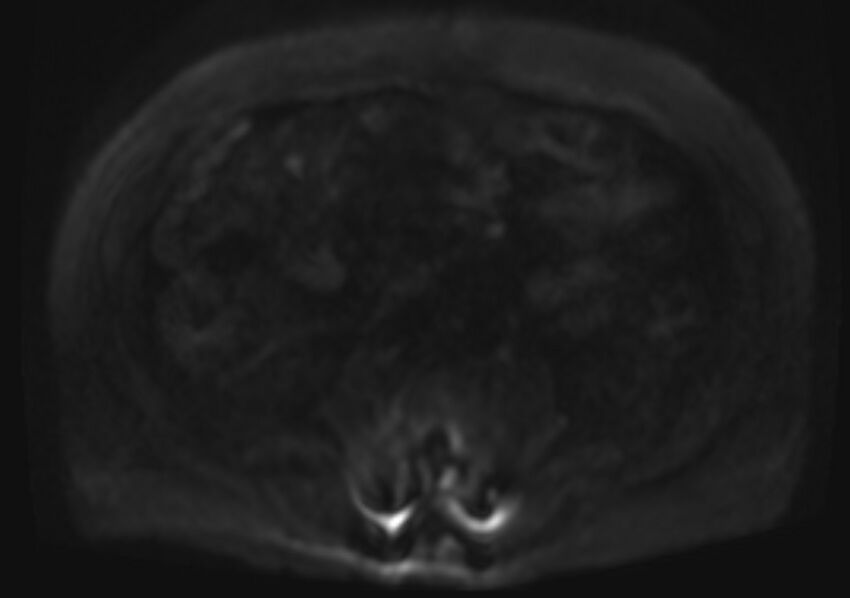 Acute portal vein thrombosis (Radiopaedia 73198-83925 Axial DWI 56).jpg
