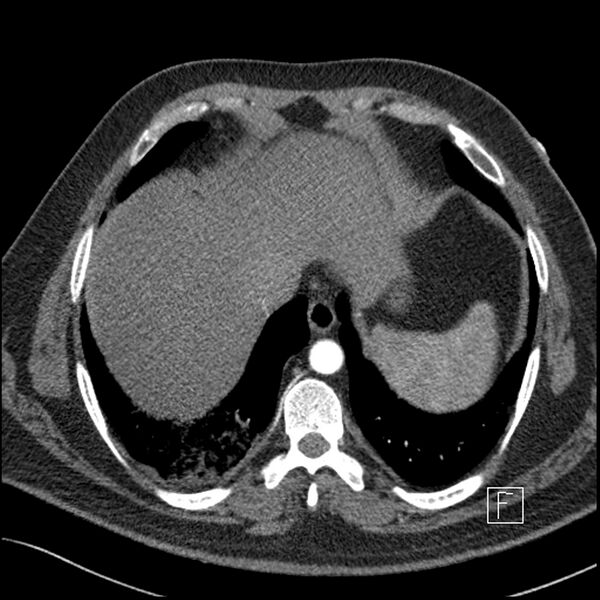 File:Acute pulmonary embolism with pulmonary infarct (Radiopaedia 73062-83768 Axial C+ CTPA 63).jpg