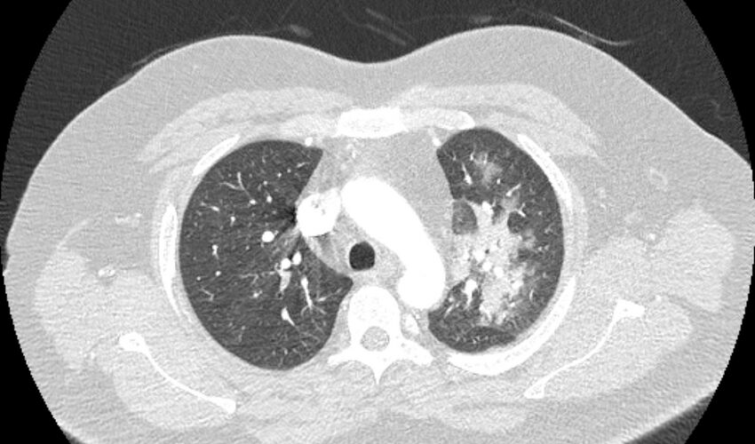 Acute pulmonary embolism with pulmonary infarcts (Radiopaedia 77688-89908 Axial lung window 26).jpg