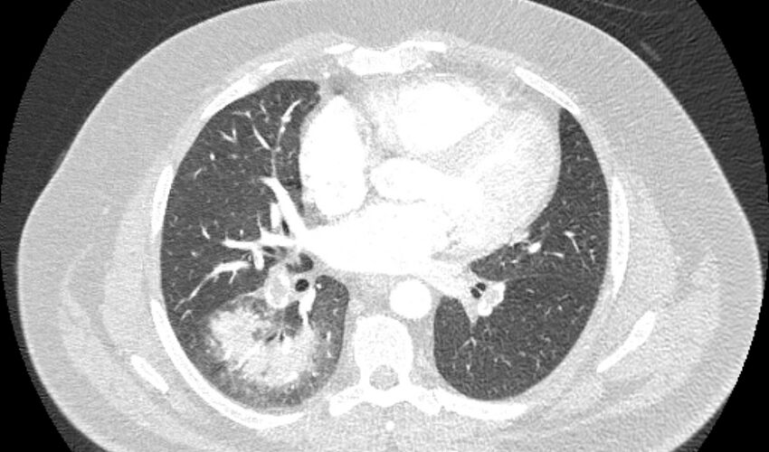 Acute pulmonary embolism with pulmonary infarcts (Radiopaedia 77688-89908 Axial lung window 68).jpg