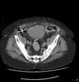 Acute renal failure post IV contrast injection- CT findings (Radiopaedia 47815-52557 Axial non-contrast 66).jpg