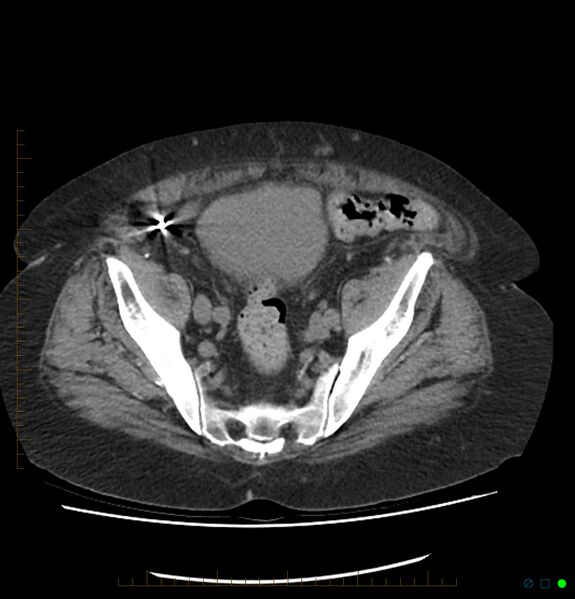 File:Acute renal failure post IV contrast injection- CT findings (Radiopaedia 47815-52557 Axial non-contrast 66).jpg