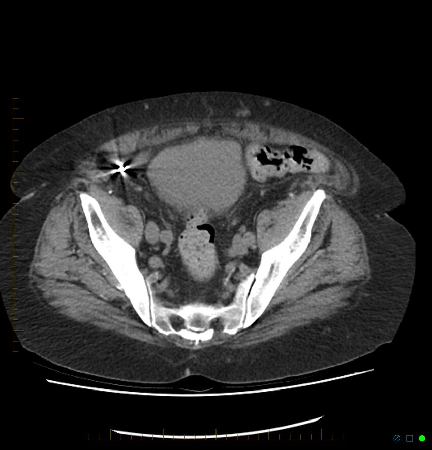 Acute renal failure post IV contrast injection- CT findings (Radiopaedia 47815-52557 Axial non-contrast 66).jpg