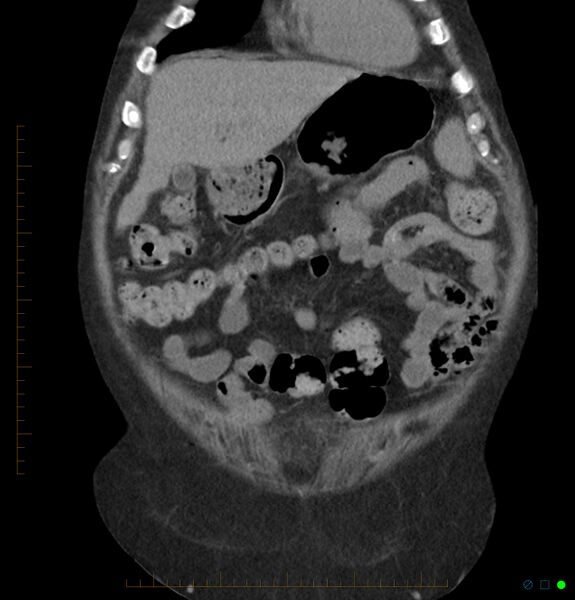File:Acute renal failure post IV contrast injection- CT findings (Radiopaedia 47815-52557 Coronal non-contrast 8).jpg