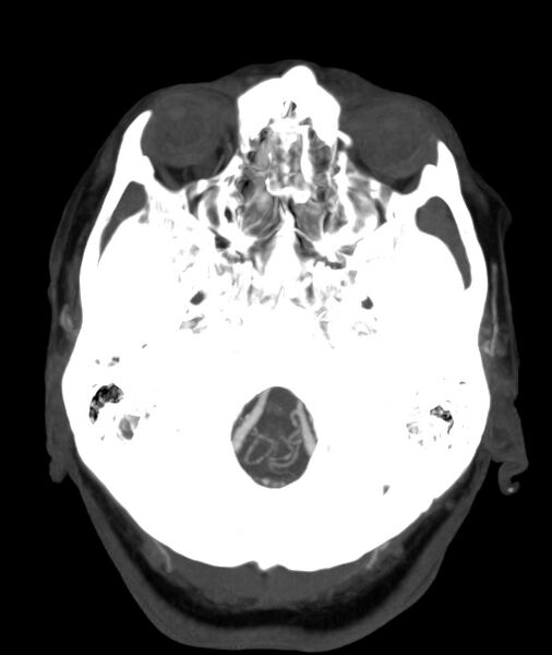 File:Acute right MCA M1 occlusion (Radiopaedia 62268-70454 Axial Phase 1 27).jpg