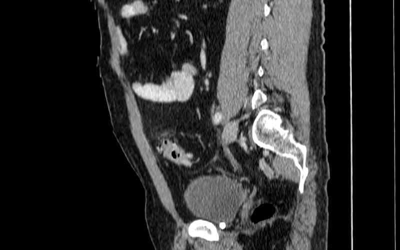 File:Acute sigmoid colon diverticulitis (Radiopaedia 55507-61976 Sagittal C+ portal venous phase 36).jpg