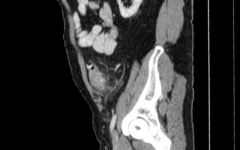 File:Acute sigmoid colon diverticulitis (Radiopaedia 55507-61976 Sagittal C+ portal venous phase 83).jpg