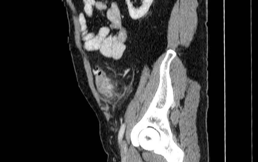 Acute sigmoid colon diverticulitis (Radiopaedia 55507-61976 Sagittal C+ portal venous phase 83).jpg