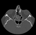 Acute sinusitis (Radiopaedia 23161-23215 Axial bone window 41).jpg