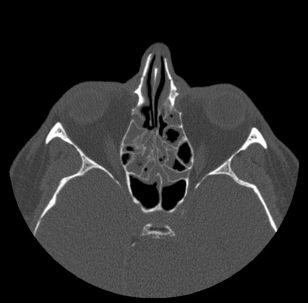 File:Acute sinusitis (Radiopaedia 23161-23215 Axial bone window 41).jpg