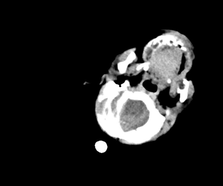 File:Acute ventriculitis (Radiopaedia 57502-64459 Axial non-contrast 3).jpg