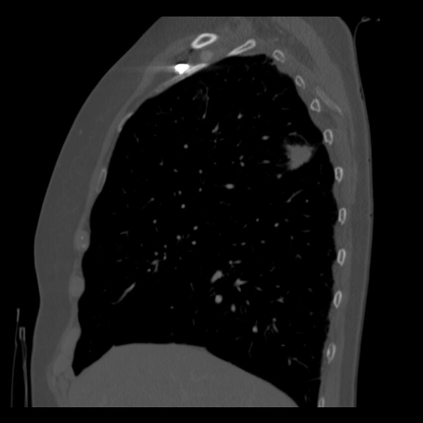 Adenocarcinoma of the lung (Radiopaedia 41015-43755 Sagittal bone window 27).jpg