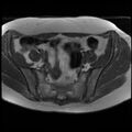 Adenoma malignum of the cervix (Radiopaedia 24460-24765 T1 4).jpg