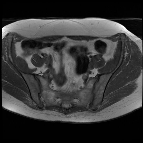 File:Adenoma malignum of the cervix (Radiopaedia 24460-24765 T1 4).jpg