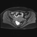 Adenomyosis and endometriotic cysts (Radiopaedia 82300-96367 Axial T1 C+ fat sat 18).jpg