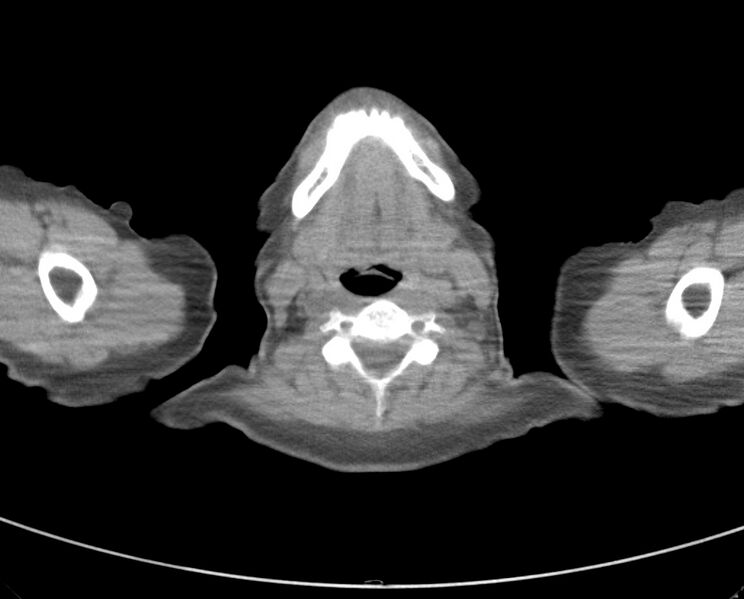 File:Adenosquamous lung carcinoma (Radiopaedia 22035-22030 non-contrast 1).jpg
