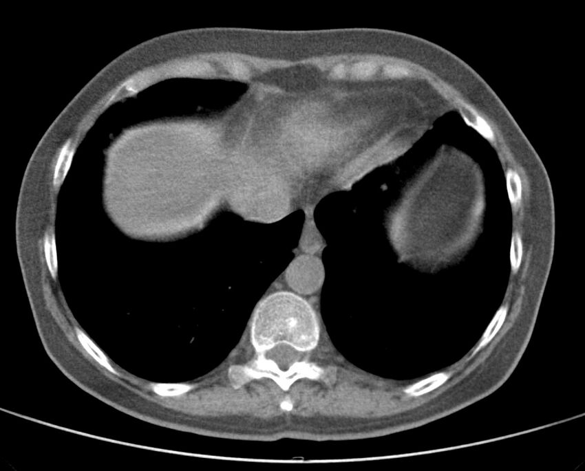 Adenosquamous lung carcinoma (Radiopaedia 22035-22030 non-contrast 48).jpg