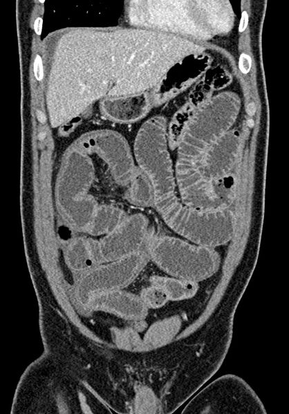 File:Adhesional small bowel obstruction (Radiopaedia 58900-66131 Coronal C+ portal venous phase 92).jpg