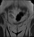 Adnexal multilocular cyst (O-RADS US 3- O-RADS MRI 3) (Radiopaedia 87426-103754 Sagittal T2 27).jpg