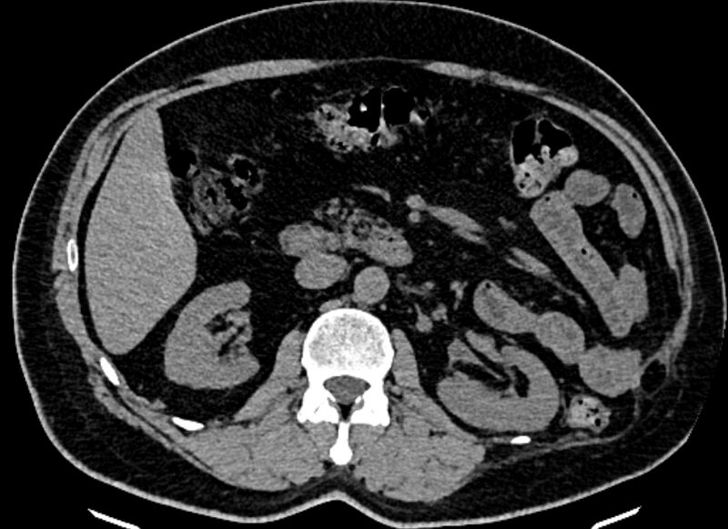 File:Adrenal metastases (Radiopaedia 73082-83791 Axial non-contrast 78).jpg