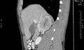 Adrenal pheochromocytoma (Radiopaedia 35133-36726 Sagittal C+ portal venous phase 10).jpg