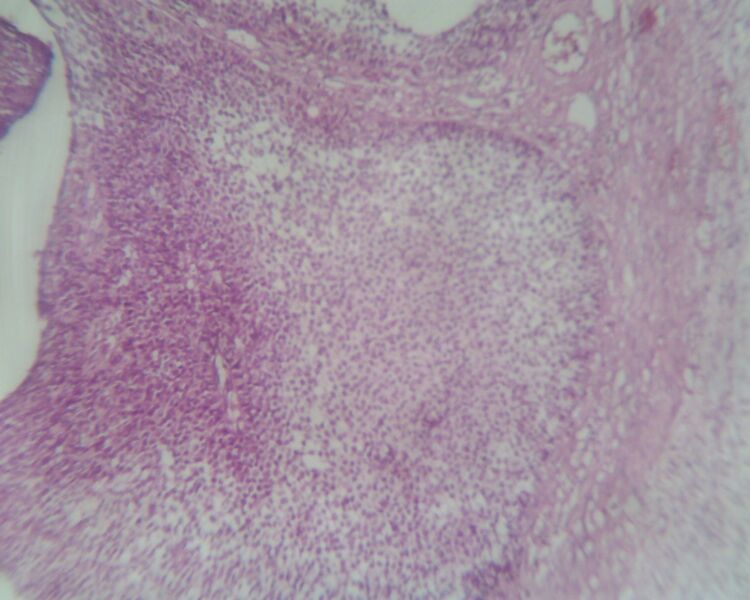 File:Adult granulosa cell tumor of the ovary (Radiopaedia 64991-74394 10x H&E 1).jpg