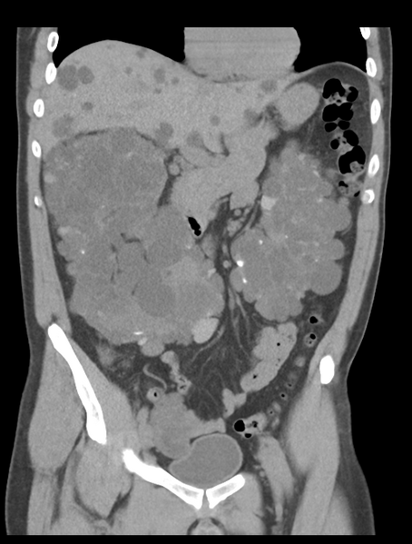 File:Adult polycystic kidney disease (Radiopaedia 47866-52626 Coronal non-contrast 18).png