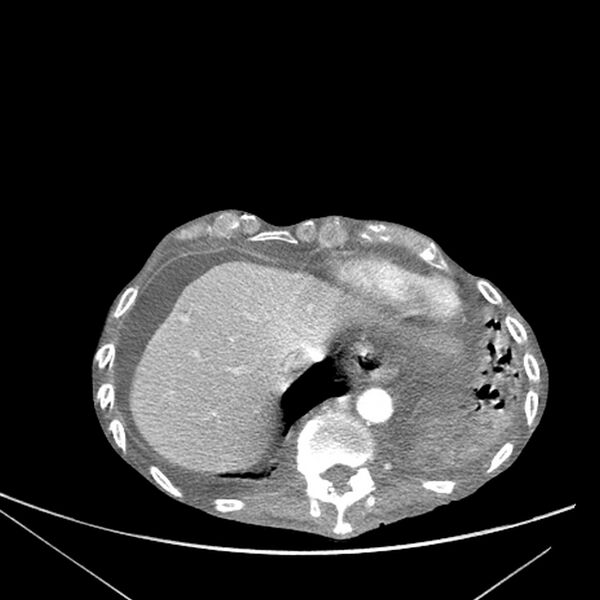 File:Advanced pulmonary tuberculosis (Radiopaedia 8599-9431 Axial liver window 17).jpg