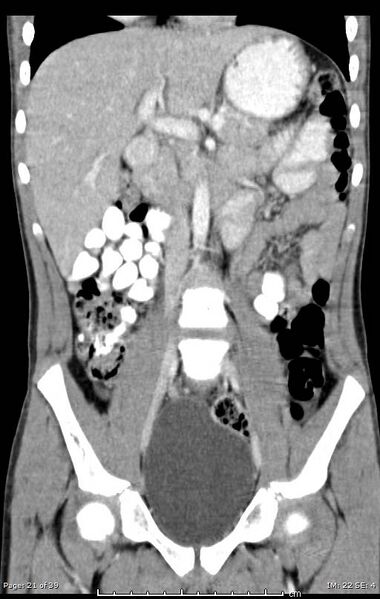 File:Agenesis of the gallbladder (Radiopaedia 55454-61905 A 21).jpg