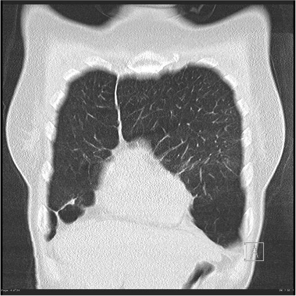 File:Alpha-1-antitrypsin deficiency (Radiopaedia 26537-26678 Coronal lung window 4).jpg