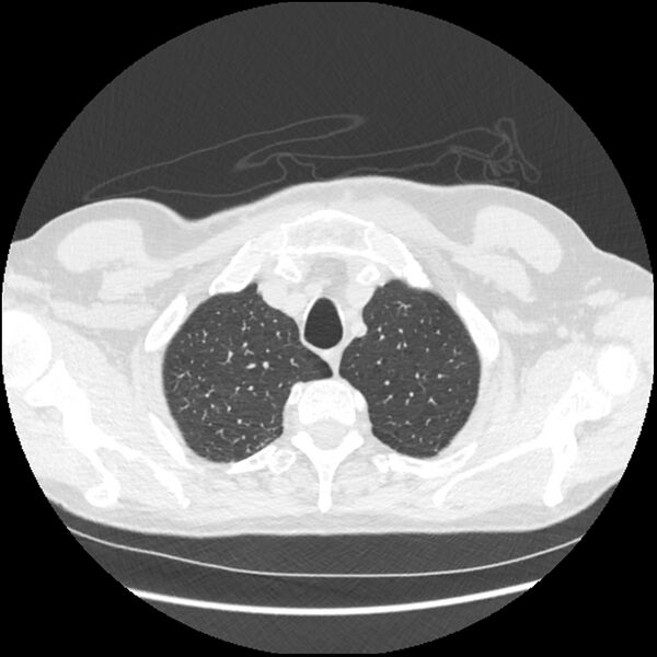 File:Alpha-1-antitrypsin deficiency (Radiopaedia 40993-43722 Axial lung window 27).jpg