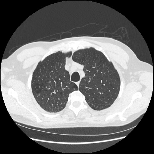 File:Alpha-1-antitrypsin deficiency (Radiopaedia 40993-43722 Axial lung window 39).jpg