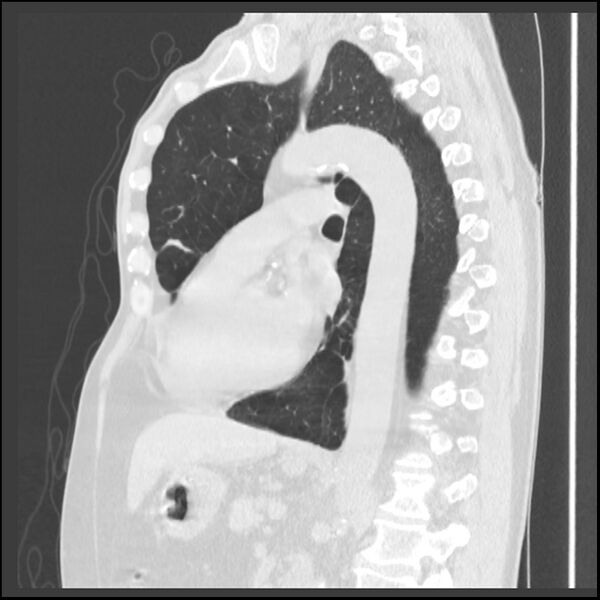 File:Alpha-1-antitrypsin deficiency (Radiopaedia 40993-43722 Sagittal lung window 117).jpg