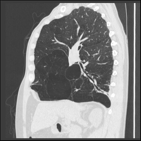 File:Alpha-1-antitrypsin deficiency (Radiopaedia 40993-43722 Sagittal lung window 167).jpg