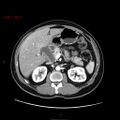 Ampullary carcinoma (Radiopaedia 56396-63056 B 28).jpg