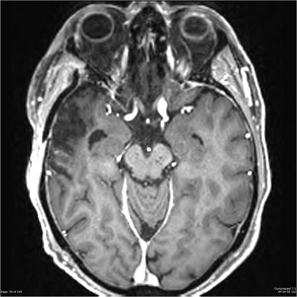 File:Anaplastic meningioma with recurrence (Radiopaedia 34452-35788 Axial T1 C+ 54).jpg