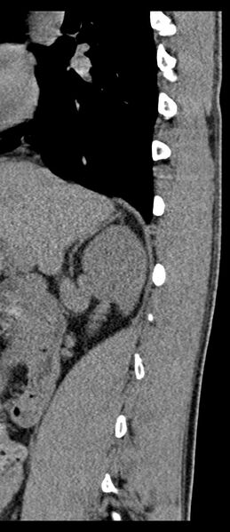 File:Aneurysmal bone cyst T11 (Radiopaedia 29294-29721 E 64).jpg