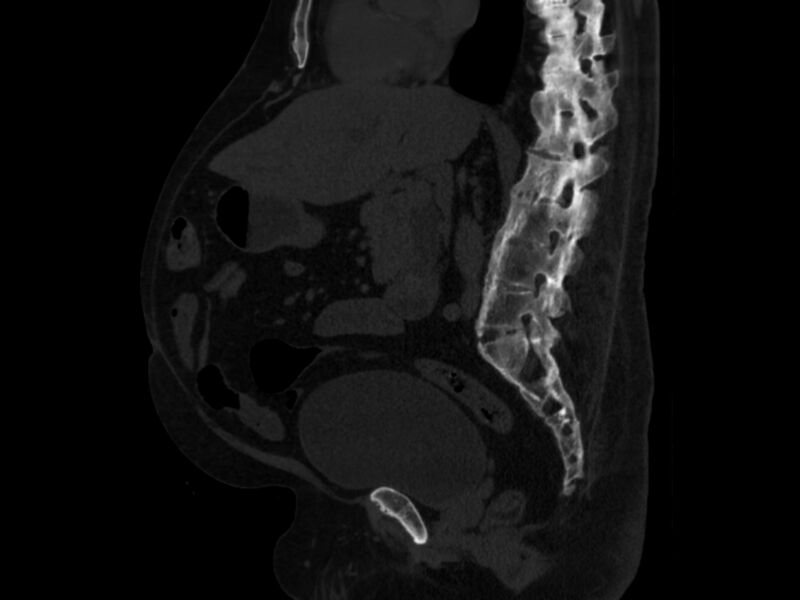 File:Ankylosing spondylitis (Radiopaedia 44609-48357 Sagittal bone window 49).jpg