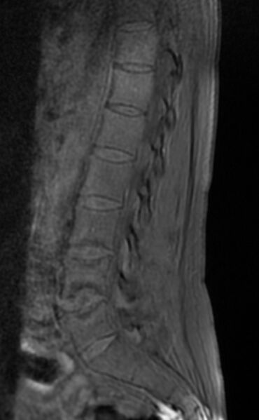 File:Ankylosing spondylitis - Andersson lesion (Radiopaedia 81878-95838 Sagittal T1 fat sat 8).jpg