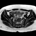 Ano-vaginal fistula (Radiopaedia 29765-30284 Axial T2 24).jpg