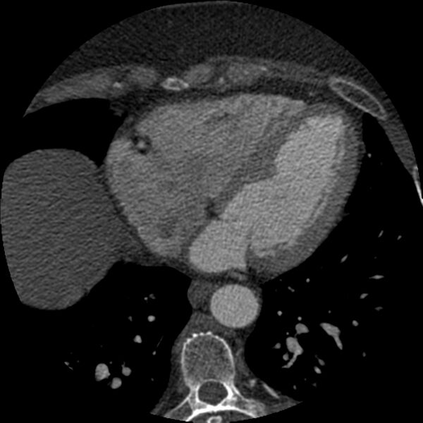 File:Anomalous origin of left circumflex artery from right coronary sinus (Radiopaedia 72563-83117 B 122).jpg