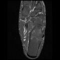 Anterior calcaneal process fracture (Radiopaedia 74654-85611 Axial PD fat sat 20).jpg