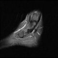 Anterior calcaneal process fracture (Radiopaedia 74654-85611 Sagittal PD fat sat 2).jpg