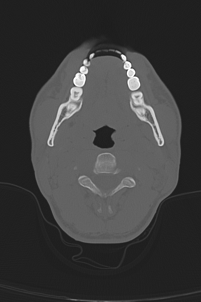 File:Anterior nasal spine fracture (Radiopaedia 46138-50494 Axial bone window 66).png