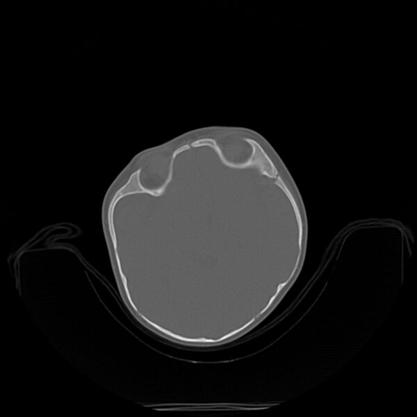 File:Anterior plagiocephaly (Radiopaedia 71836-82273 C 24).jpg