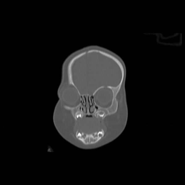File:Anterior plagiocephaly (Radiopaedia 71836-82273 Coronal bone window 15).jpg