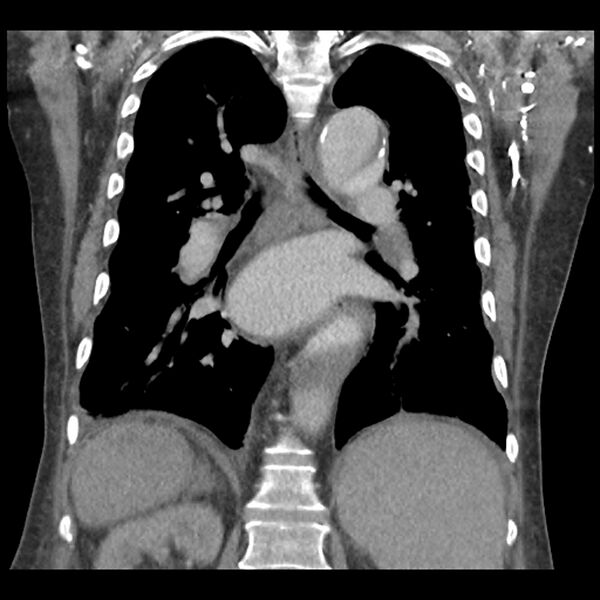 File:Aortic arch graft infection (FDG PET-CT) (Radiopaedia 71975-82437 Coronal 40).jpg