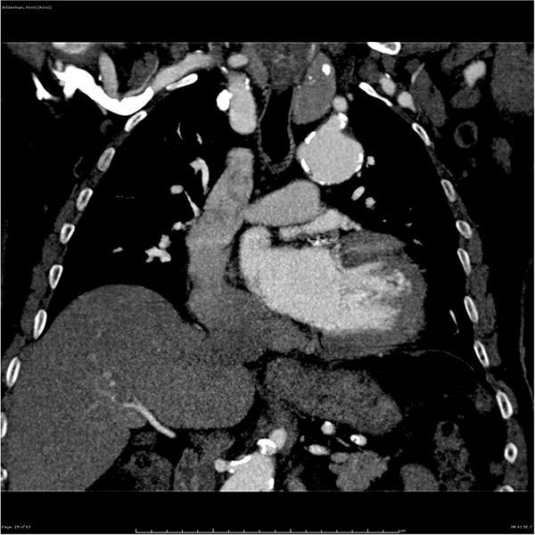 File:Aortic dissection - Stanford type A (Radiopaedia 26183-26315 A 28).jpg