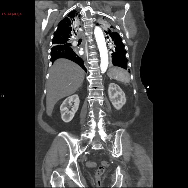 File:Aortic intramural hematoma (Radiopaedia 27746-28001 B 41).jpg