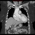 Aortic valve stenosis (Radiopaedia 14480-14423 A 6).jpg